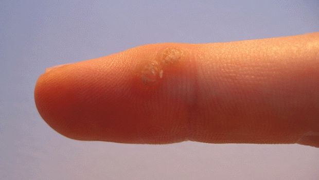 Мозоль на пальце возле ногтя на руке thumbnail